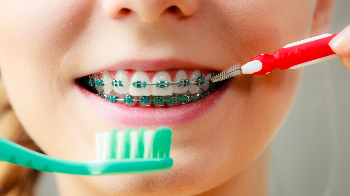 Cleaning Your Braces in Issaquah, WA