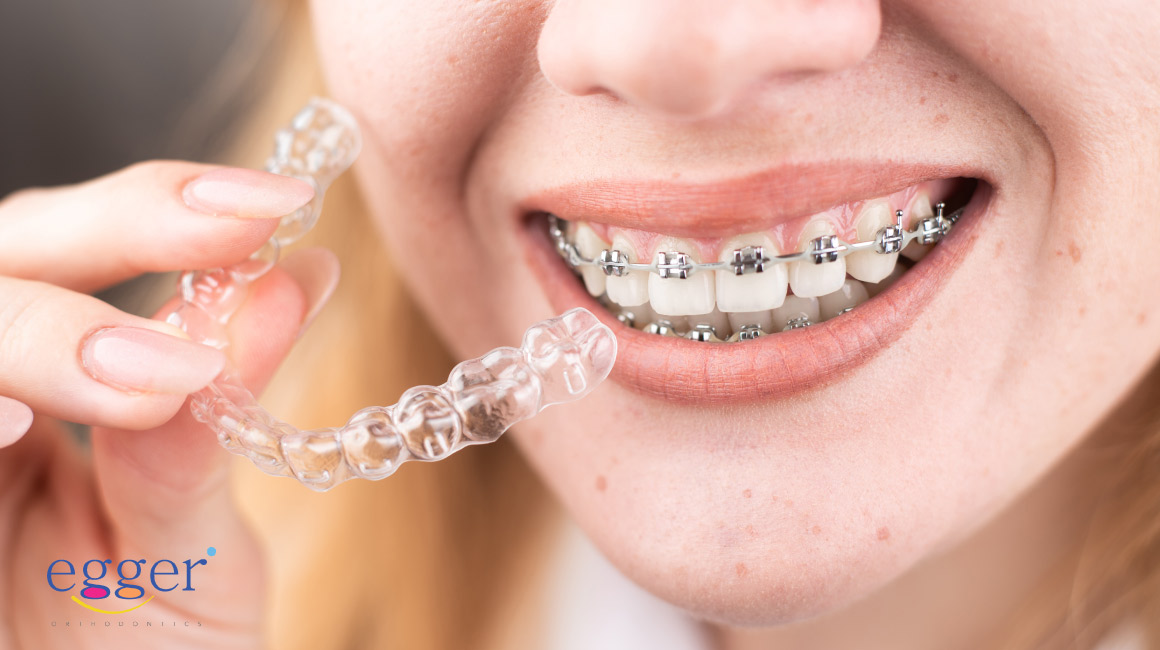 Braces vs. Invisalign: Choosing the Right Fit for Your Smile