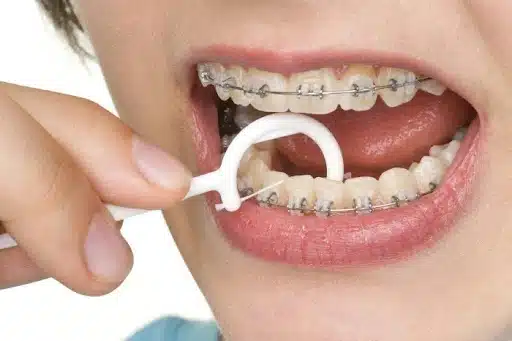 Person using floss threaders for braces to floss around brackets
